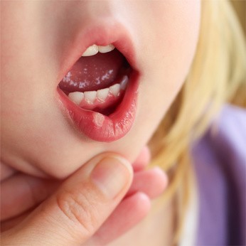 Małe, bolesne owrzodzenia w jamie ustnej zwane aftami powstają w wyniku nieodpowiedniej higieny, chorób zębów czy mechanicznych uszkodzeń.