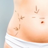 Zmiany po ciąży zwykle widoczne są w okolicy brzucha. Za sprawą abdominoplastyki skóra na brzuchu ponownie jest naciągnięta.   