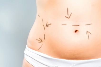 Zmiany po ciąży zwykle widoczne są w okolicy brzucha. Za sprawą abdominoplastyki skóra na brzuchu ponownie jest naciągnięta.   