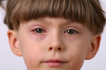 W ostatnich latach nastąpił wzrost zachorowań na choroby alergiczne oczu.     