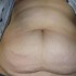 Brzuch z rozstępami. Ze zdjęcia ciężko wywnioskować, czy jest to kwestia nadwagi, czy uszkodzenia powłok brzusznych  m.in. mięśni brzucha , wymagających zabiegu chirurgicznego  plastyki brzucha .   