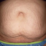 Brzuch bez oznak luźnej skóry, za to z dużą ilością rozstępów. Po objętości brzucha można by podejrzewać, że Pani jest tuż po porodzie, ale sądząc po wyglądzie rozstępów to raczej nadmiar tkanki tłuszczowej powoduje taki wygląd. W tym przypadku proponuję dietę oraz zabiegi redukujące tkankę tłuszczową i jednocześnie ujędrniające skórę np. Exilis. Na rozstępy polecam zabiegi laserowe, które zmniejszą ich widoczność i jednocześnie ujędrniają skórę.   