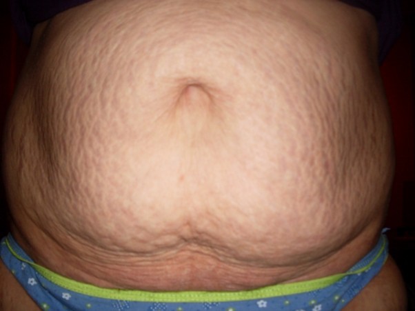 Brzuch bez oznak luźnej skóry, za to z dużą ilością rozstępów. Po objętości brzucha można by podejrzewać, że Pani jest tuż po porodzie, ale sądząc po wyglądzie rozstępów to raczej nadmiar tkanki tłuszczowej powoduje taki wygląd. W tym przypadku proponuję dietę oraz zabiegi redukujące tkankę tłuszczową i jednocześnie ujędrniające skórę np. Exilis. Na rozstępy polecam zabiegi laserowe, które zmniejszą ich widoczność i jednocześnie ujędrniają skórę.   