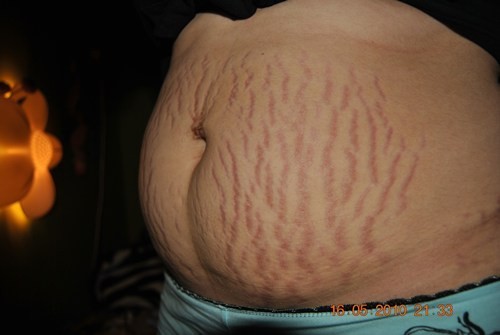 Na brzuchu widać czerwone rozstępy, co oznacza, że powstały niedawno. Być może Pani jest niedługo po porodzie i skóra brzucha nie zdążyła się jeszcze obkurczyć.   