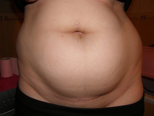 Skóra na brzuchu jest napięta, widoczna jest nadwaga. Ze zdjęcia ciężko ocenić, ale chyba występują pojedyncze rozstępy. Polecam zabiegi redukujące tkankę tłuszczową.  