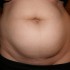 Skóra na brzuchu jest napięta, widoczna jest nadwaga. Ze zdjęcia ciężko ocenić, ale chyba występują pojedyncze rozstępy. Polecam zabiegi redukujące tkankę tłuszczową.  