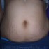 Duży nadmiar tkanki tłuszczowej oraz dużo rozstępów. Przede wszystkim dieta, a następnie ujędrnianie skóry oraz laserowa redukcja rozstępów.  