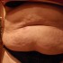 Nadmiar skóry i tkanki tłuszczowej, duża ilość rozstępów. Proponuję dietę i zabiegi redukujące tkankę tłuszczową, następnie ujędrnianie skóry i laser na rozstępy.  