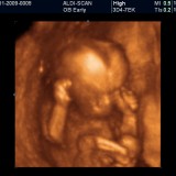 11 tydzień ciąży. Dziecko mierzy już 5-6 cm. Coraz lepiej przez cienką skórę widać jego naczynia krwionośne. Uwidacznia się szyja (główka już nie jest przyklejona do tułowia)