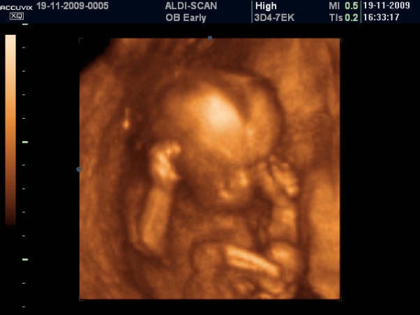 11 tydzień ciąży. Dziecko mierzy już 5-6 cm. Coraz lepiej przez cienką skórę widać jego naczynia krwionośne. Uwidacznia się szyja (główka już nie jest przyklejona do tułowia)