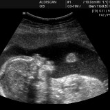 18 tydzień ciąży. Dziecko może mieć nawet 18 cm długości i ważyć 200 gram