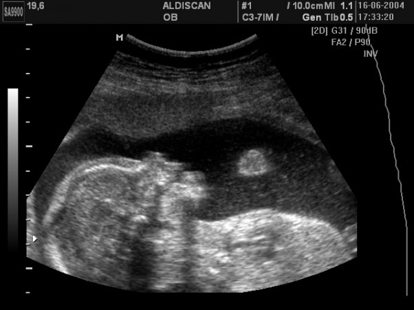 19 tydzień ciąży. Na najbliższym USG masz szansę dowiedzieć się, czy masz synka czy córeczkę