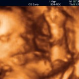 23 tydzień ciąży. Maluch przypomina już noworodka – choć jest zaledwie jego miniaturką. Waży ok. 400-450 gram, gdyby wyprostował nóżki, może mieć 30 cm długości