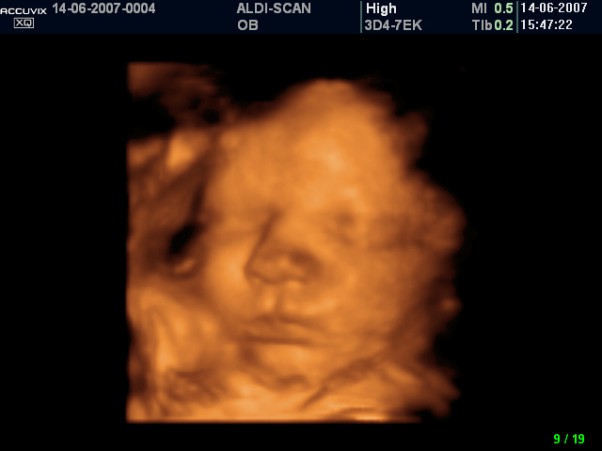 33 tydzień ciąży. Podczas badania USG zobaczysz, w jakiej pozycji znajduje się twoje dziecko. Jeśli nie ułożyło się główką do dołu, lekarz będzie się zastanawiał zapewne nad cięciem cesarskim.