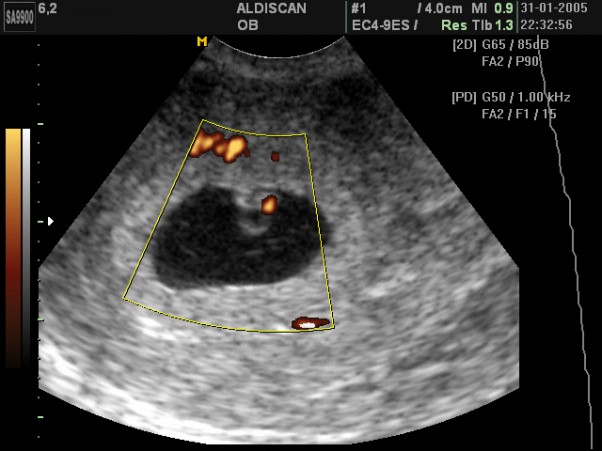 6 tydzień ciąży. Twoje dziecko mierzy teraz 4 mm. Zarodek ma już główkę, tułów i ogonek (zniknie)