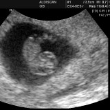 8 tydzień ciąży. Jeśli w tym tygodniu ginekolog będzie robił USG, zobaczysz bijące serce dziecka