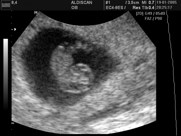8 tydzień ciąży. Jeśli w tym tygodniu ginekolog będzie robił USG, zobaczysz bijące serce dziecka