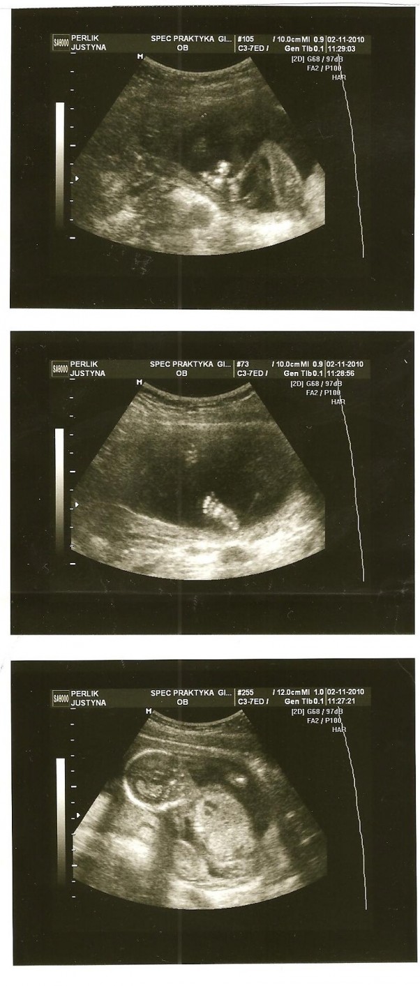 nasze pierwsze USG 16 tydzień ciąży\n:&#41; rozwijamy się bardzo ładnie i dajemy dużo radości przyszłym rodzicom ^^
