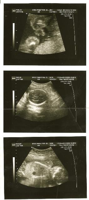 nasze drugie USG 20 tydzień ciąży\ni tu podobno widać iż Nasz Szkrab jest chłopcem :&#41;