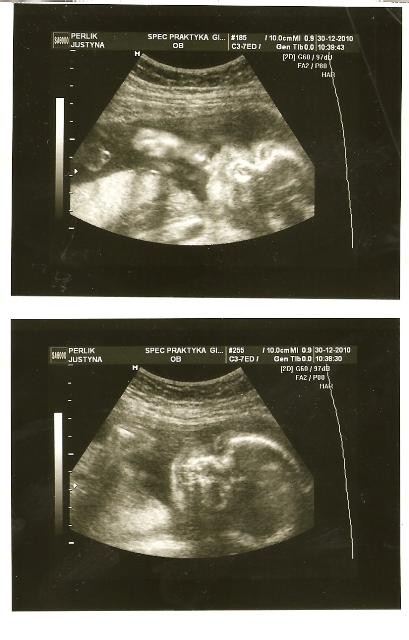 nasze trzecie USG 24 tydzień ciąży \nMały Szkrab ssa już paluszki :&#41;