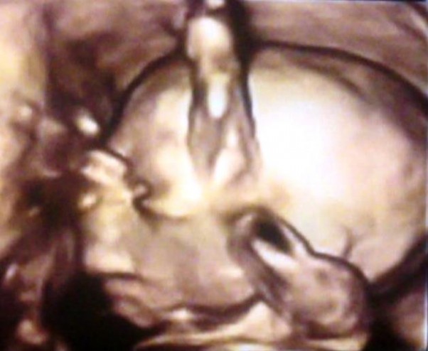  to moje najkorzystniejsze zdjęcie prenatalne &#45; wysokie czółko po Tatuniu i banan w dół po Mamuni
