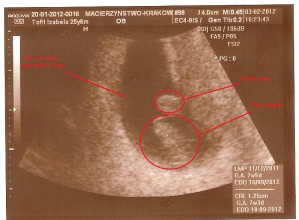 kuleczka zdjęcie 2 zdjęcie opisane &#45; 7 tydzień ciąży