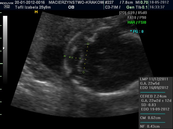 Główka Amelki Badanie połówkowe 22 tydzień ciąży