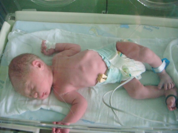Mateuszek synuś tuż po urodzeniu,przeniesiony do inkubatora